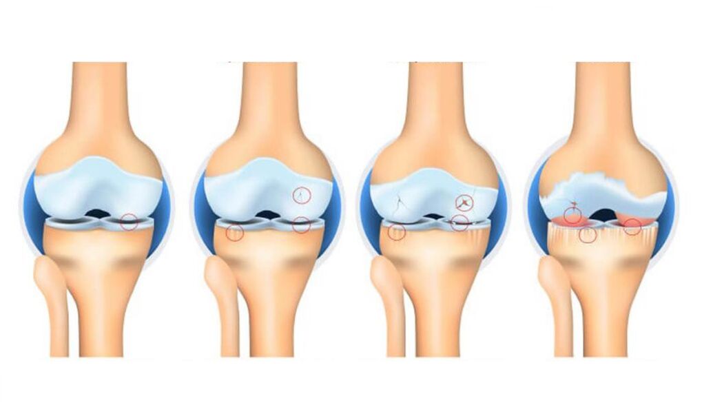 stage of knee joint arthrosis