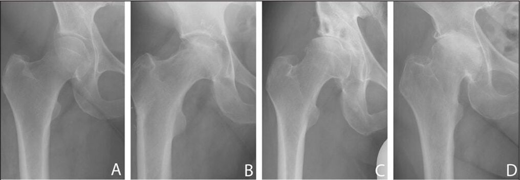 The stage of development of hip joint arthrosis on x-ray