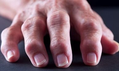 What is the difference between arthritis from arthrosis