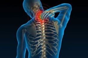 Cervical osteochondrosis leads to pain in the neck